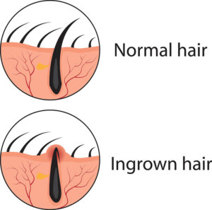 waxing with an Ingrown hair in Tampa